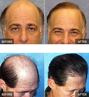 Before and after results